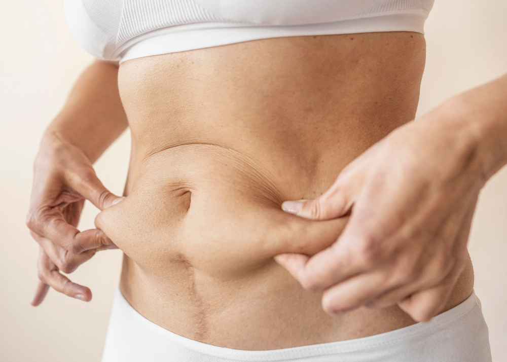 Abdominoplastika
